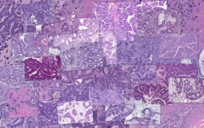 Exascale Computing Project Contributes to Accelerating Cancer Research